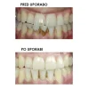 Silk'n ToothWave TW1PE3001 thumbnail