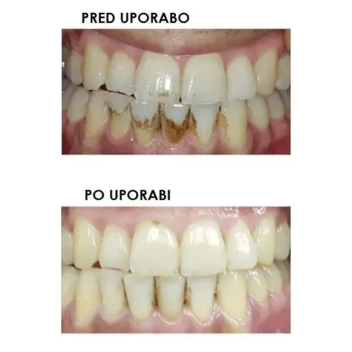 Silk'n ToothWave TW1PE3001 - 4